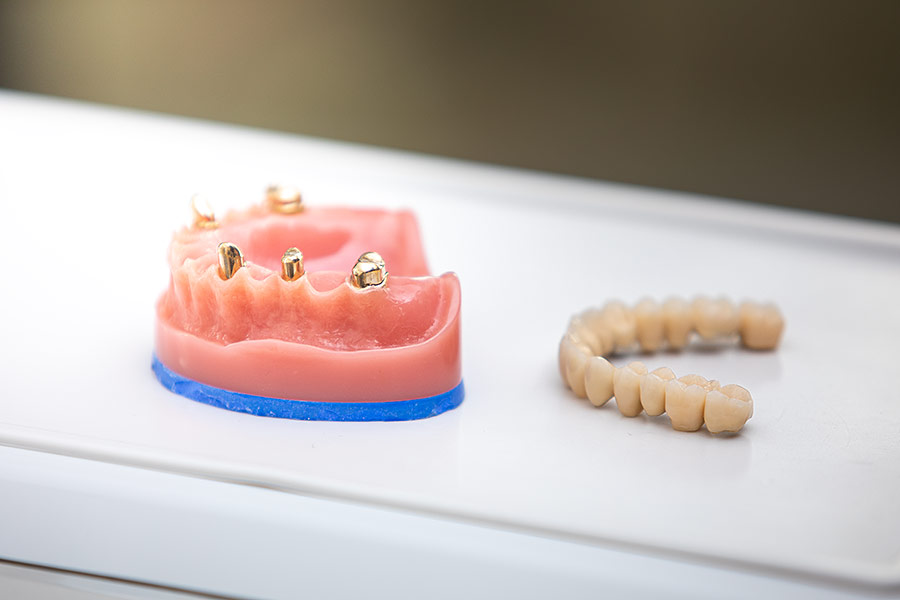 Prosthetic O Rings Dental prosthetics and prosthodontics | Uwe Frings